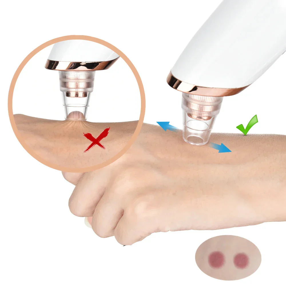 Electric Blackhead Remover