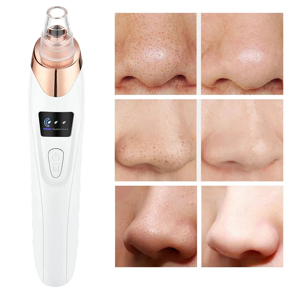 Electric Blackhead Remover